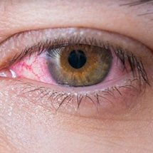 GLAUCOMA TREATMENT