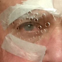CATARACT SURGERY